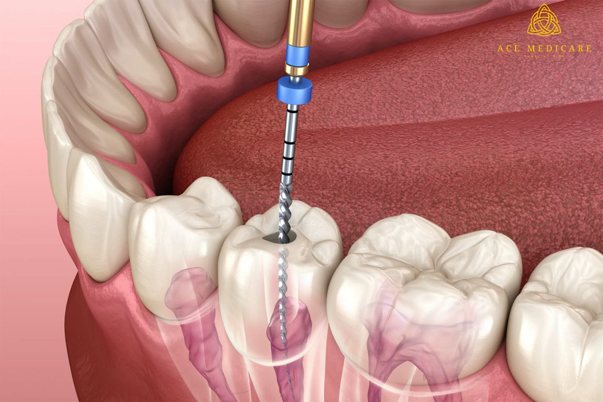 Root Canal Treatment: A Look at Aftercare and Recovery Tips